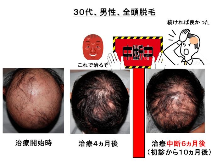 円形脱毛症　病院